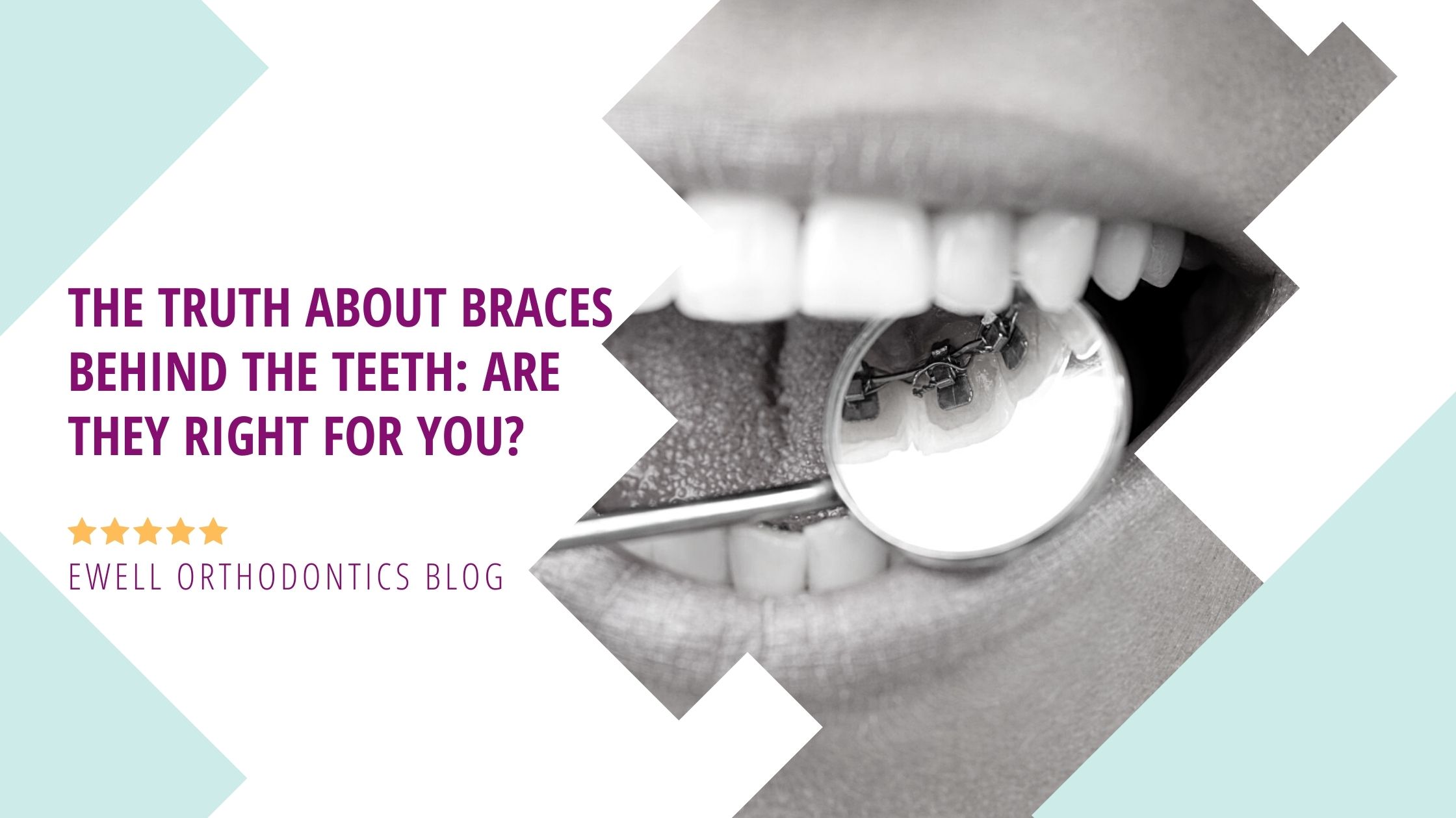 10 Questions To Ask Before Getting Braces